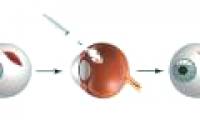Super glue helps 'bandage' injured eyeballs within minutes