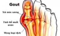 Symptoms, complications of gout and medication treatment