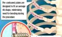 Synthes Rib Matrix - new surgical method that helps fracture to recover quickly