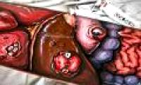 Teratomas: The type of tumor that grows without any rules, also ... grows both teeth and hair