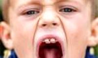 The boy has shark teeth