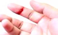 The cause of a person suffering from hemophilia
