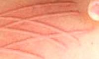 The cause of hives is not well known