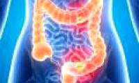 The cause of young people with bowel cancer is 4 times higher than the previous generation