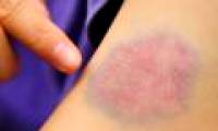 The diseases are most likely to cause death when you are young