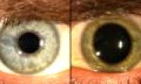 The eye changes color after curing Ebola