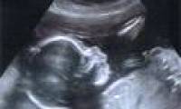 The fetus is born after 3 months in the brain dead