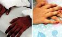 The girl was hand grafted from black young man, 2 years after the miracle happened