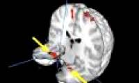 The human brain changes after experiencing a plane crash