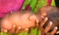 The Indian Baby Skull Girl born in India is like a meatball without limbs