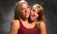 The most famous conjoined twins: Sharing the same body for 34 years, their current life is surprising
