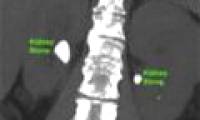 The new method allows two kidneys to be removed at the same time