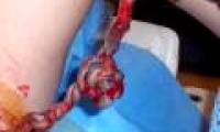 The North has had umbilical cord blood bank