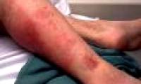The outbreak of scarlet fever outbreaks in Hong Kong