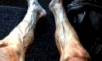 The reason why the athlete's foot is horribly deformed
