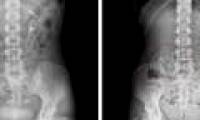 The reason why this woman's kidneys fell down to ... pelvic holes