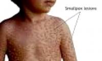 The risk of dispersing smallpox virus through biological weapons