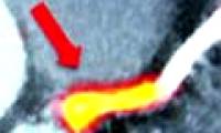 The risk of heart attack can be detected by new tomography techniques