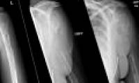The strange disease caused the patient's bones to