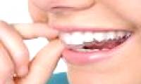 The unknown about braces throughout Invisalign