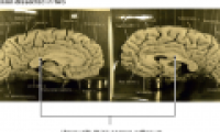 The untold story about Einstein's brain