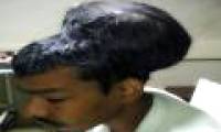 The world's largest brain tumor removal surgery in India