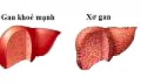 There are several stages in cirrhosis?  What are acute cirrhosis f1, f2, f3, f4?