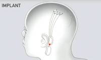 Thousands of people line up to have brain chips implanted