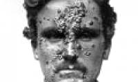 To know how horrible the antibiotic scenario is, go back to the past