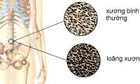 Top 4 foods are 'Kings of calcium theft', causing many people to break bones from minor falls