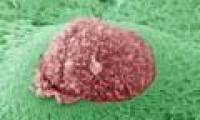 Tumor metastasis formation like?
