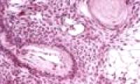 Turn stem cells into cancer machines