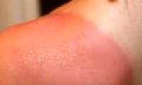 Types of sunburn you may encounter in hot weather