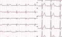 Unknown things about ECG
