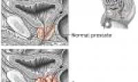 Use immunity to reduce prostate cancer risk