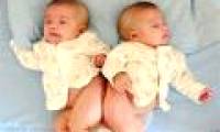Using 3D technology to recreate conjoined twins body parts