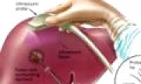 Vietnam has successfully treated liver cancer with radioactive microspheres