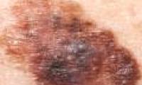 Warning of antioxidants accelerates cancer metastasis