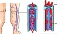 What are venous thromboembolism?