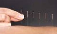 What is acupuncture?