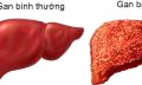 What is cirrhosis?  Who is most likely to develop cirrhosis?