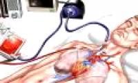 What is ECMO?  When does the patient need ECMO intervention?