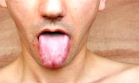 What is syphilis?