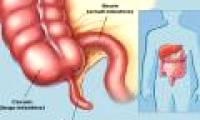 What is the effect of appendicitis?