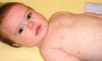 What should I do when my child has a red rash like a mosquito bite?