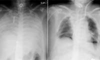 White lung disease: Causes, symptoms and treatments