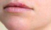 WHO warns: 50% of the world's population can get Herpes
