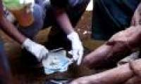 WHO warns that leprosy is spreading rapidly in India