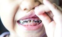 Why do children always have tooth decay?