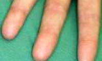 Why people do not have fingerprints?